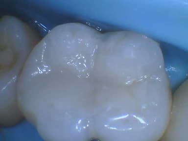 Dental Filling Transformation After