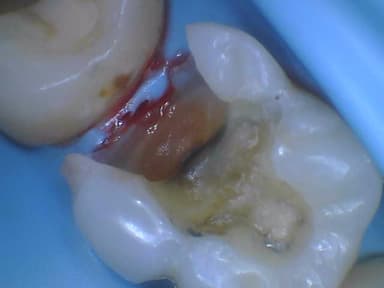 Dental Filling Transformation Before