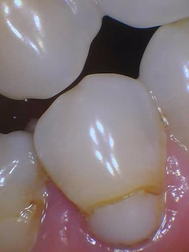Dental Filling Transformation Before